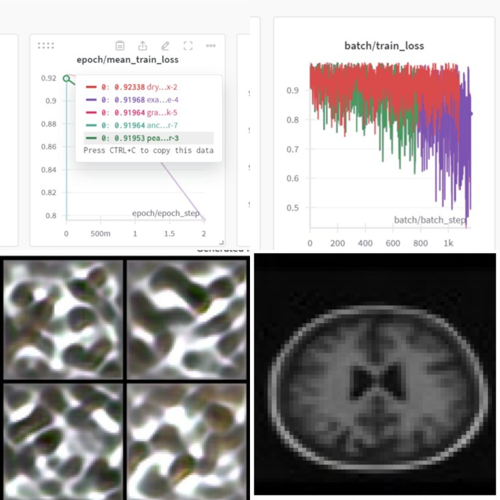Synthetic Brain MRI with Gen AI